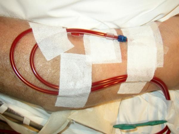 A clinical photograph of a human forearm showing the setup for hemodialysis or continuous venovenous hemofiltration (CVVH). Two large-bore (15-gauge) cannulas are inserted into an arteriovenous (AV) fistula. The tubing is filled with blood, appearing as dark red columns within the translucent flexible plastic. The catheters are secured to the limb using a systematic arrangement of white rectangular gauze pads and medical adhesive tape. One visible connector features a clear Luer lock housing with a blue-coded hub. The tubes run parallel to each other across the arm before looping towards the dialysis machine. This procedural image demonstrates vascular access management and stabilization techniques used in renal replacement therapy. The orientation shows a typical clinical setting for a patient undergoing high-flow extracorporeal blood purification.