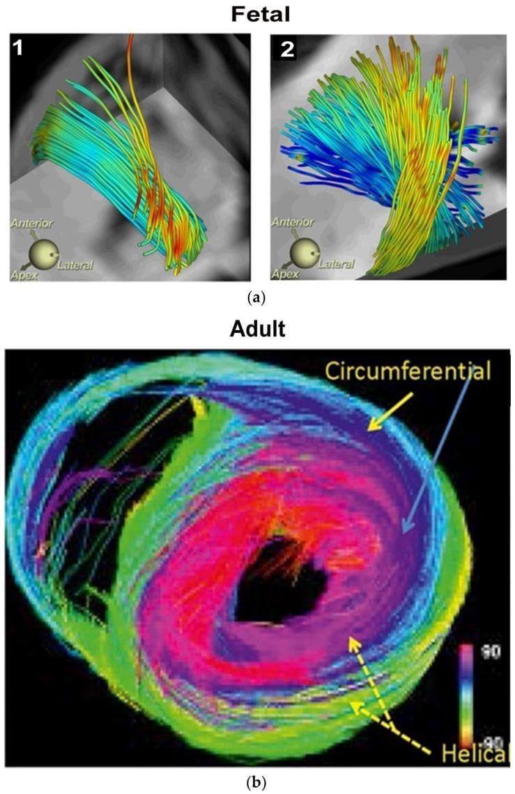 This medical visual consists of Diffusion Tensor MRI (DT-MRI) tractography images illustrating human myocardial fibrillogenesis and adult ventricular fiber architecture. Panel (a) displays fetal heart development at 10 weeks (1) and 14 weeks (2), showing the progression from simple, parallel fiber bundles to a more complex, interwoven helical arrangement of myocardial fibers. Panel (b) presents an adult heart in cross-section, utilizing a color-coded directional map to define spatial fiber orientation. The adult model highlights the distinct layers of the Helical Ventricular Myocardial Band (HVMB): right-handed helical fibers (red), left-handed helical fibers (green/yellow), and circumferential fibers (blue/purple) forming an outer wrap. A key anatomical feature demonstrated is the absence of circumferential fibers within the interventricular septum, where oblique helical fibers predominate. The progression from fetal to adult stages illustrates the development of the ventricular rope-like configuration necessary for efficient twisting and suction mechanics during the cardiac cycle. This diagnostic imaging serves as an educational tool for understanding cardiac embryology, anatomy, and functional pathophysiology.