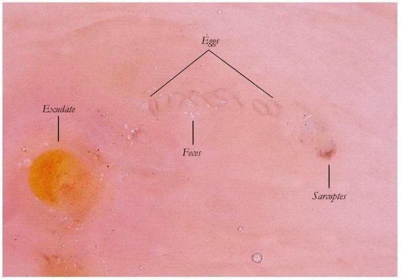 This clinical image demonstrates an enhanced wet dermatoscopy view of a scabies Mite-Gallery Unit (MGU) on human skin. The image reveals the internal anatomical components of a Sarcoptes scabiei burrow, which is made visible by the transparency of the stratum corneum in wet modality. Key features include: 1) The 'Sarcoptes' mite located at the head of the gallery, appearing as a slightly opalescent, dark-pigmented structure. 2) A row of 'Eggs' following the mite, characterized by their oval morphology and arranged with their major axes perpendicular to the burrow's path. 3) Scybala or 'Feces', appearing as small, white-gray refractile spheres within the tunnel body. 4) An adjacent 'Exudate' in the lower-left quadrant, presenting as a semitransparent, yellowish-orange circular region with irregular borders, representing a spongiotic inflammatory response. This visual material is critical for understanding the diagnostic 'jet trail' sign and the lifecycle-based morphology of Sarcoptes scabiei during clinical dermatological examinations.