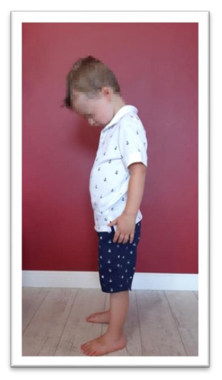 This clinical photograph shows a pediatric patient in a standing position, illustrating the standardized test for Tonic Labyrinthine Reflex (TLR) flexion. The child is depicted in a lateral profile, demonstrating a controlled forward flexion of the head with the chin tucked toward the chest. The trunk remains upright but slightly inclined anteriorly, while the upper and lower extremities are positioned naturally—arms at the sides and feet parallel on the floor. In the context of neurodevelopmental assessment, this position is used to evaluate the integration of primitive reflexes. Clinicians observe for compensatory motor patterns that indicate incomplete reflex integration, such as fist-clenching, involuntary knee deflection, or loss of postural balance triggered by the vestibular stimulus of head flexion. The image serves as an educational reference for pediatric physical therapy and neurological examination protocols in preschool-aged children.