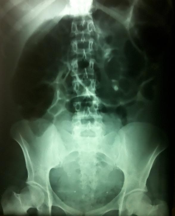 This diagnostic image is an anteroposterior plain abdominal X-ray (ASP) demonstrating a severe large bowel obstruction. The most prominent feature is a massive, gas-filled distension of the colon, characteristic of a sigmoid volvulus. A classic 'coffee bean sign' or 'double jambage' appearance is visible, where a greatly dilated loop of the sigmoid colon rises out of the pelvis and occupies the majority of the abdominal cavity. The bowel walls are stretched and thin, and the haustral markings are largely absent in the most distended segments. Background anatomical structures including the lumbar spine, sacrum, and iliac crests are visible but partially obscured by the overlying gaseous distension. The lack of significant distal rectal gas and the presence of such extreme proximal colonic dilation are key radiological markers for high-grade intestinal obstruction. This image serves as a clinical teaching tool for identifying surgical emergencies such as volvulus or dolichocolon complications in a post-partum or acute abdominal scenario.