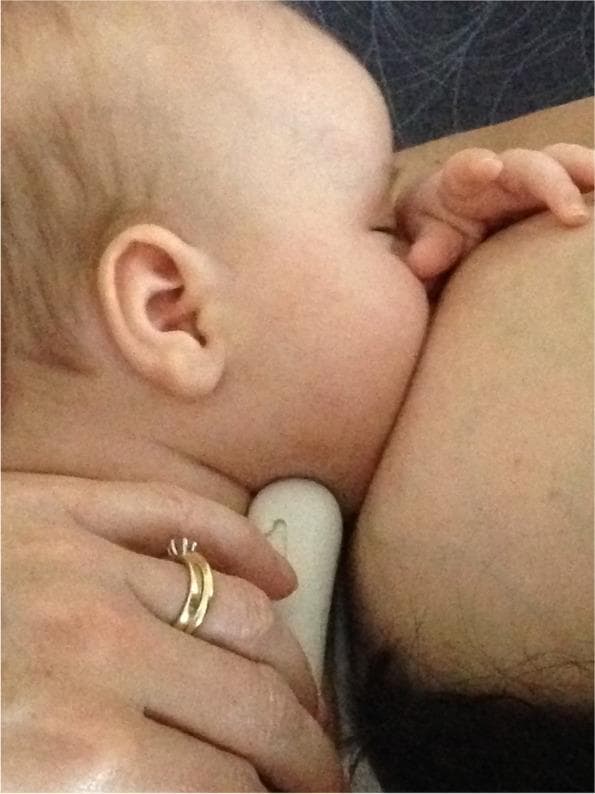 A clinical photograph depicting an infant latched onto a mother's breast during breastfeeding. The image provides a close-up, lateral view of the infant's head and neck in relation to the breast tissue. The infant is positioned with the chin pressed firmly into the breast, demonstrating an asymmetrical latch. The infant's upper body is oriented horizontally, and the nose appears clear of the breast tissue. A caregiver's hand is visible at the bottom of the frame, providing support to the infant's neck and base of the skull to maintain positioning. The photograph illustrates post-intervention breastfeeding mechanics following a 'gestalt' clinical approach, which focuses on optimizing maternal-infant positioning and attachment to address issues like nipple pain and poor milk transfer. The educational focus is on the visual assessment of latch quality, specifically the deep attachment and chin-breast contact required for effective suckling and maternal comfort.
