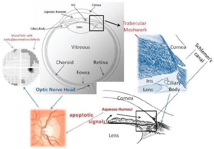 This composite educational diagram illustrates the pathophysiology of glaucoma, focusing on the aqueous humor outflow pathway and its impact on the posterior segment. A central cross-sectional anatomical diagram identifies the cornea, iris, lens, ciliary body, vitreous, retina, fovea, and optic nerve head. An inset provides a high-magnification view of the iridocorneal angle, detailing the trabecular meshwork and Schlemm’s canal. A 3D blue-tinted microscopic representation highlights the fibrous structure of the trabecular meshwork. The diagram demonstrates the functional relationship between malfunctioning trabecular meshwork and the generation of 'apoptotic signals' that travel to the optic nerve head. The clinical consequences are represented by a fundus photograph of an optic nerve head with neuroretinal rim thinning and a corresponding visual field plot showing early glaucomatous arcuate defects. Arrows indicate the flow of aqueous humor and the progression of damage from the anterior chamber to the retinal ganglion cells, emphasizing the mechanio-biological link between increased intraocular pressure and irreversible visual loss.