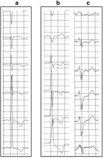 Diagnostic Image: This figure displays three vertical panels (a, b, and c) of electrocardiogram (ECG) rhythm strips comparing different clinical presentations and temporal progressions. Panel a shows a regular sinus rhythm with narrow QRS complexes and relatively normal morphology in an asymptomatic patient. Panel b illustrates high-voltage R waves and deep S waves, which are characteristic findings of left ventricular hypertrophy (LVH) in a patient later diagnosed with Fabry disease. Panel c demonstrates further pathological progression over two years, showing widened QRS complexes with notching, slurred segments, and pronounced T-wave inversions, suggesting worsening conduction delay and ventricular strain. The comparison highlights the transition from subtle electrical signs of hypertrophy to significant cardiomyopathy-related ECG abnormalities, including high voltage, repolarization disturbances, and morphological changes associated with progressive non-ischemic dilated cardiomyopathy.
