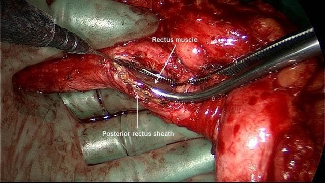 This intraoperative clinical photograph captures a key step in a sublay (Rives-Stoppa) incisional hernia repair. The image demonstrates the dissection of the abdominal wall layers to create a retromuscular space. A linear incision has been made through the posterior rectus sheath near the linea alba, which is held open by surgical instruments to expose the underlying posterior aspect of the rectus abdominis muscle. This specific surgical maneuver is essential for entering the retro-rectus plane, where a prosthetic mesh will eventually be placed. The anatomical structures are clearly labeled: the 'Posterior rectus sheath' is seen as the fascial layer being retracted, and the 'Rectus muscle' is visible within the developed space. The surgical field shows the use of metallic forceps and a dissecting instrument, illustrating the transition from superficial to deep abdominal wall layers. This visual is used to teach medical students and surgical residents the technique of retromuscular plane development and anatomical identification during complex ventral hernia repairs.