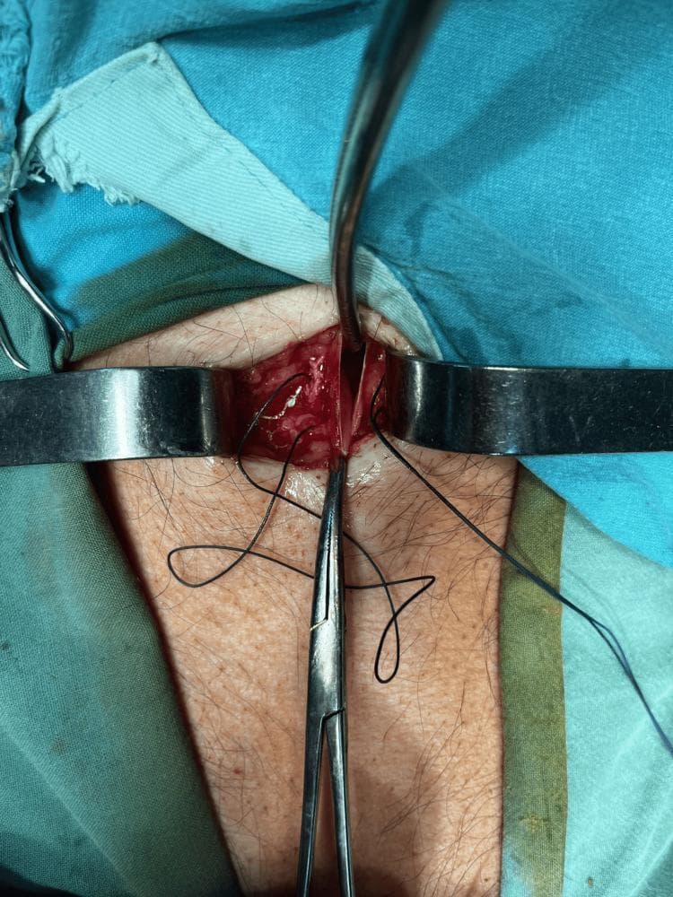 This clinical photograph provides an intraoperative view of a 20-mm vertical subxiphoid incision during a surgical procedure for catheter placement. The surgical field is prepared with sterile teal and light-green drapes, exposing a small area of skin with visible terminal hair. A metallic self-retaining retractor is positioned horizontally to maintain lateral traction, widening the incision and providing access to the underlying subcutaneous tissue. A surgical needle holder is oriented vertically at the inferior aspect of the wound, currently being used to manipulate dark, non-absorbable sutures that are pre-placed along the incision edges. The image demonstrates the technique for creating access to the abdominal cavity under local anesthesia, specifically for the induction of preoperative progressive pneumoperitoneum in cases of giant inguinal hernias with loss of domain. This visual emphasizes surgical site exposure, instrument handling, and the application of stay sutures in a controlled, minor surgical approach.
