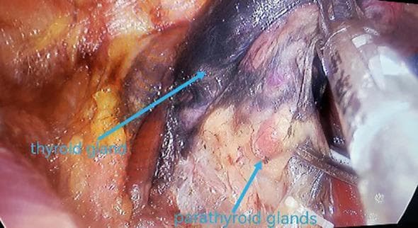 This intraoperative clinical photograph demonstrates the concept of 'negative opacification' during a thyroidectomy and central lymph node dissection. Following the injection of a nanocarbon suspension, the thyroid gland and central compartment lymph nodes exhibit significant black staining as they absorb the lymphatic tracer. In contrast, the parathyroid glands are highlighted by their failure to take up the nanocarbon, appearing as distinct, lighter-colored (yellow-tan) structures against the darkened thyroid tissue. Blue arrows and text labels specifically identify the blackened thyroid gland and the relatively pale parathyroid glands. This technique serves as a surgical aid to facilitate the identification and preservation of parathyroid glands in situ while ensuring the radical clearance of potentially metastatic, stained lymph nodes. The image illustrates a critical step in endocrine surgery for protecting parathyroid function and improving oncological outcomes in thyroid carcinoma cases.