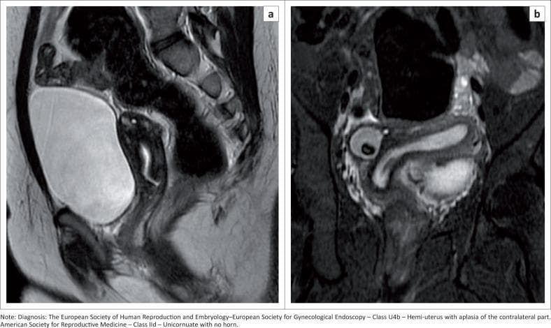 This diagnostic image consists of two MRI T2-weighted sequences (a and b) illustrating a Müllerian duct anomaly. Image (a) is a sagittal T2-weighted sequence showing the uterus where the hyperintense endometrial cavity does not extend to the fundal region, suggesting a structural malformation. Image (b) is a coronal oblique T2-weighted sequence demonstrating a unicornuate uterus (Class U4b hemi-uterus under ESHRE-ESGE classification). The functional uterine component shows a characteristic curved, 'banana-shaped' endometrial cavity displaced toward the left side of the pelvis. In the right adnexal region, a well-defined lesion consistent with a benign teratoma is visible. The imaging highlights the importance of true coronal and sagittal planes in evaluating uterine fundal contour and endometrial cavity morphology for the classification of congenital uterine anomalies. This content is relevant for radiology and obstetrics/gynecology trainees focusing on pelvic anatomy and congenital reproductive tract variations.