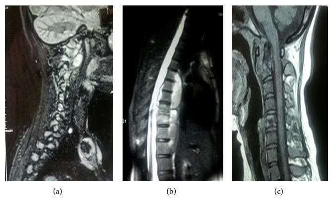 This composite diagnostic image consists of three sagittal MRI views (a, b, and c) of the spinal column demonstrating multisegmental tuberculous spondylitis (Pott disease). Panel (a) is a sagittal T2-weighted sequence showing the cervical spine with signal hyperintensity and irregularities at the craniovertebral junction and upper cervical levels, suggestive of inflammatory involvement and prevertebral edema. Panel (b) shows the thoracic spine with significant pathology, including destruction and collapse of mid-thoracic vertebral bodies (D7-D8 region) and a large, hyperintense anterior fluid collection (cold abscess) extending from D5 to D8. This collection causes mass effect and compression of the spinal cord. Panel (c) is a T1-weighted sagittal view of the cervical spine further detailing the loss of normal vertebral architecture and prevertebral soft tissue thickening. Collectively, these images illustrate characteristic findings of spinal tuberculosis: spondylodiscitis, vertebral destruction, and paraspinal abscess formation across non-contiguous spinal levels.