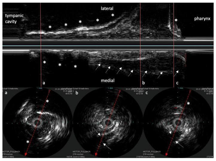 This diagnostic image displays Intravascular Ultrasound (IVUS) scans of the human Eustachian Tube (ET), featuring a longitudinal reconstruction and three corresponding circular cross-sections (a, b, and c). The longitudinal view (top) illustrates the ET's path from the tympanic cavity to the pharynx. Highly echogenic areas marked with asterisks (*) identify bony structures, which serve as consistent anatomical landmarks. The ET cartilage is characterized by low echogenicity (hypoechoic), indicated by white arrows on the medial aspect. The circular cross-sections correspond to specific anatomical locations indicated by vertical red lines in the longitudinal view: (a) represents the ET isthmus, showing surrounding bone; (b) represents the middle cartilaginous section; and (c) represents the area near the pharyngeal ostium. A dashed red line in each cross-section indicates the reconstruction axis, while the arrow tips indicate the orientation relative to the longitudinal view. This educational material demonstrates the use of high-resolution endoluminal ultrasound to distinguish between bony, cartilaginous, and soft tissue components of the ET for diagnostic or interventional planning.