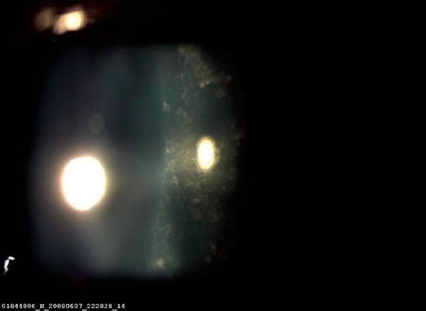 This clinical photograph displays a slit-lamp examination of the eye, specifically focusing on a posterior subcapsular cataract. The central and posterior regions of the lens exhibit granular, irregular, and diffuse opacities scattered throughout the subcapsular region. These opacities are highlighted by two primary light reflexes: a large, bright circular reflex on the nasal side and a more focused, intense reflex on the temporal side. The pathology appears as multiple scattering centers within the lens material, creating a mottled or snowflake-like texture that disrupts light transmission along the visual axis. This finding is characteristic of a posterior subcapsular cataract, which in this clinical context is associated with lightning strike trauma (electric cataract). The visual demonstrates how the pathology reduces lens clarity and interferes with light entry, providing an educational example of traumatic lens injury and secondary cataract formation.
