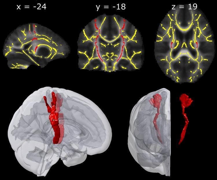 Educational neuroimaging figure illustrating the Regions of Interest (ROIs) for the corticospinal tract (CST) and Tract-Based Spatial Statistics (TBSS). The upper row presents 2D multiplanar slices in sagittal (x=-24), coronal (y=-18), and axial (z=19) views. These slices are group maps displaying mean Fractional Anisotropy (FA) in stereotactic MNI-152 space. Overlaid on the grayscale anatomy is a yellow-coded TBSS skeleton representing central white matter tracts and red-coded ROIs specifically delineating the bilateral corticospinal tracts. The lower panel provides a 3D volumetric rendering of the red CST ROIs. Two views show the ROIs in situ within a translucent gray brain template, demonstrating their descent from the primary motor and sensory hand areas through the internal capsule. A third isolated 3D model on the far right displays the distinct morphology of the tract. This visual is designed for advanced neuroanatomy or radiology education, focusing on white matter tractography and the spatial distribution of the descending motor pathway.