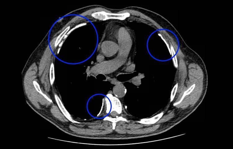 This diagnostic image is an axial (transverse) computed tomography (CT) scan of the thorax at the level of the aortic arch, displayed in a mediastinal window. The image demonstrates hallmark signs of asbestos exposure through the presence of multiple, discrete pleural plaques. These plaques are highlighted with blue circles and appear as well-circumscribed, high-density (hyperattenuating) focal thickenings along the parietal pleura. Key anatomical landmarks include the central mediastinum containing the great vessels, bilateral dark air-filled lungs, and the surrounding thoracic cage with visible ribs and the posterior vertebral column. The plaques are distributed bilaterally along the lateral chest wall and in the paravertebral region, showing a characteristic plateau-like morphology and increased radiodensity compared to adjacent soft tissue, occasionally suggesting focal calcification. This finding is clinically significant for diagnosing asbestos-related pleural disease and serves as a radiological marker for prior occupational exposure, increasing the suspicion for associated conditions like mesothelioma or lung cancer.