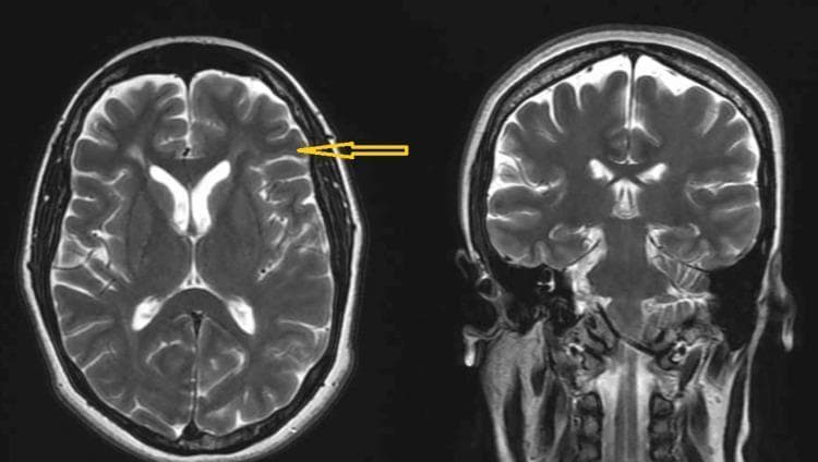 This diagnostic imaging set consists of two T2-weighted magnetic resonance imaging (MRI) scans of the human brain: an axial view on the left and a coronal view on the right. Both images demonstrate normal neuroanatomical findings and bilateral symmetry between the cerebral hemispheres. In the axial section, the lateral ventricles are clearly visible as hyperintense (bright) fluid-filled spaces, surrounded by well-defined deep gray matter structures including the thalamus and basal ganglia. The cerebral cortex shows preserved sulcation and gyration with distinct gray-white matter differentiation. An orange arrow in the axial view points toward the cortical surface of the left frontal lobe. The coronal section displays the vertical orientation of the brainstem, cerebellum, and the relationship between the cerebral hemispheres and the ventricular system. There is no evidence of midline shift, focal lesions, edema, or space-occupying masses in either plane. These images serve as a baseline for normal intracranial anatomy in a clinical or educational context.