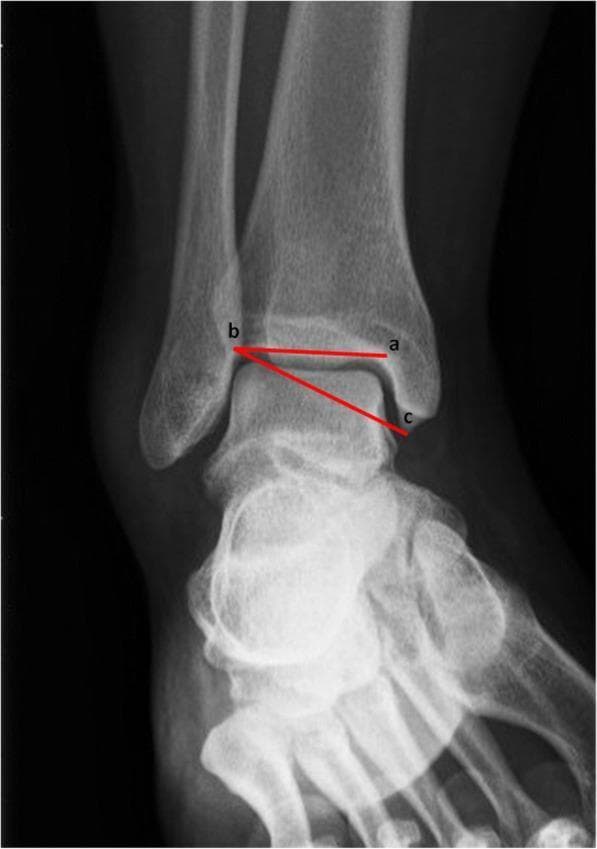 This diagnostic image is an anteroposterior (AP) x-ray radiograph of the human ankle joint, demonstrating the methodology for measuring the Medial Malleolar Height Angle (MMHA). The radiograph clearly shows the distal tibia, distal fibula, and talus. Anatomical landmarks include the medial and lateral malleoli and the tibiotalar joint space. Superimposed on the anatomy are two red lines intersecting at point 'b' to define the MMHA. Line 'a-b' represents the distal tibial joint orientation line, where point 'b' is the lateral-most point of the tibiotalar joint line and point 'a' is on the medial side of the joint surface. Line 'b-c' connects the lateral point of the joint line to the most distal tip of the medial malleolus (point 'c'). This measurement is utilized in orthopedic assessment to evaluate bone geometry and morphological characteristics that may contribute to chronic ankle instability (CAI). The image serves as an educational tool for clinical imaging and orthopedic residency training in ankle alignment and morphometry.