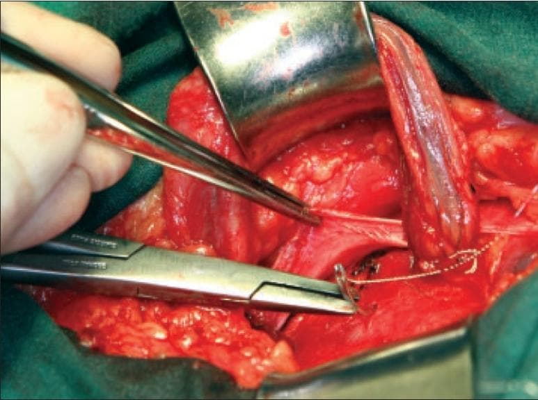 This clinical photograph shows an intraoperative view of an inguinal hernia repair, specifically demonstrating the third layer of a multi-layered anatomical reconstruction. The surgical field is exposed using a metal retractor, revealing several anatomical layers including the internal oblique muscle, the transversus abdominis, and the inguinal ligament. A pair of surgical forceps is seen elevating a thin, fibrous tissue layer—the external oblique aponeurosis—to facilitate suturing. A needle holder is actively positioning a curved needle with white non-absorbable suture to imbricate the tissues. The spermatic cord is visible and retracted to the side to ensure its protection during the posterior wall reinforcement. The procedure illustrates the technique of anchoring sutures from the internal oblique fascia to the shelving edge of the inguinal ligament, aiming to strengthen the inguinal canal's floor. The tissues appear healthy with normal vascularity, and the surgical focus is on re-establishing anatomical integrity to prevent hernia recurrence.