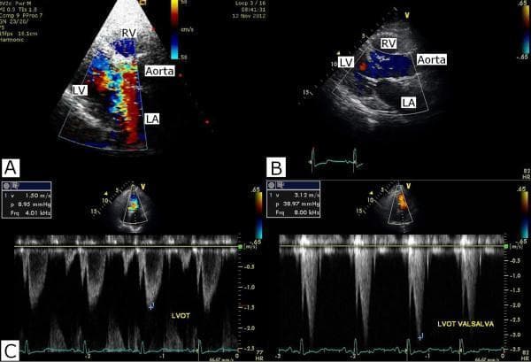 Transthoracic echocardiography series illustrating dynamic left ventricular outflow tract (LVOT) obstruction and associated mitral regurgitation (MR). Panel A shows a color Doppler apical long-axis view with a prominent mosaic, multi-colored jet originating from the LV and extending into the left atrium (LA), consistent with severe MR and systolic flow acceleration in the LVOT. Panel B demonstrates the resolution of this MR jet on follow-up imaging after intra-aortic balloon pump weaning. Panel C displays spectral Doppler tracings of the LVOT. The left tracing shows a resting state with a peak velocity (Vmax) of 1.50 m/sec and a peak pressure gradient of 8.95 mmHg. The right tracing shows a provoked state during a Valsalva maneuver, demonstrating a significant increase in obstruction with a Vmax of 3.12 m/sec and a peak pressure gradient of 38.97 mmHg. The images highlight the dynamic nature of LVOT obstruction and its relationship with secondary MR and hemodynamic maneuvers.