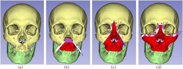 This diagnostic diagram and illustration series displays a 3D medical model of a human skull, used to demonstrate the classification of Le Fort fractures through computer-assisted clipping paths. The series includes four panels: (a) a normal skull with the cranium in pale yellow and the mandible in light green; (b) a Le Fort I fracture, indicated by a red highlight on the lower maxilla and alveolar process, separated by a horizontal plane; (c) a Le Fort II fracture (pyramidal fracture), with the red highlight extending through the nasal bridge, lacrimal bones, and infraorbital rim; and (d) a Le Fort III fracture (craniofacial dysjunction), showing the most extensive red highlight encompassing the entire midface, including the zygomatic arches and orbital floors. Overlaid white, purple, and blue geometric lines represent the implicit clipping paths used in surgical planning software to segment these complex fracture patterns. The visual serves as an educational tool for maxillofacial surgery, illustrating different levels of midfacial instability and the digital tools used for their analysis.