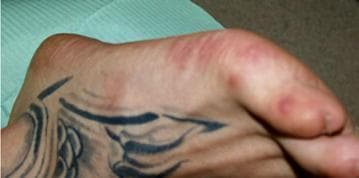This clinical photograph displays the dorsal and lateral aspect of a human foot, illustrating dermatological manifestations characteristic of Hand, Foot, and Mouth Disease (HFMD) in an adult. The skin features multiple discrete, erythematous maculopapular lesions and small vesicles. These lesions are notably concentrated along the dorsal surface of the toes and the lateral border of the foot. Some lesions appear as slightly raised, circular reddish papules, while others show signs of early vesiculation or central erosion surrounded by an inflammatory erythematous halo. The distribution is asymmetric and non-confluent. The surrounding skin exhibits mild localized erythema but otherwise maintains normal texture, aside from the presence of a decorative tattoo on the dorsal midfoot. This image serves as an educational example of the peripheral exanthem associated with Coxsackievirus or Enterovirus infections, highlighting that while primarily a pediatric condition, HFMD can present with symptomatic cutaneous involvement in adults.