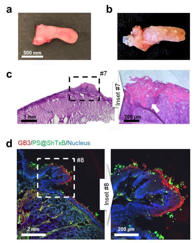 This figure illustrates the targeting of Shiga Toxin subunit B (ShTxB)-coated nanoparticles in a mouse model of oral carcinogenesis. (a) Macroscopic view of a healthy control tongue. (b) Macroscopic appearance of a tongue treated with the carcinogen 4NQO, displaying multifocal tumoral masses and leukoplakia characteristic of oral squamous cell carcinoma (OSCC). (c) Histological section (Hematoxylin and Eosin stain) of the 4NQO-treated tongue showing severe dysplasia and a focal area of invasive squamous cell carcinoma (indicated by the white arrow in inset #7). (d) Confocal immunofluorescence microscopy of a tissue cryosection demonstrating the specificity of targeted nanoparticles (PS@ShTxB). The image shows cell nuclei in blue (DAPI), the GB3 receptor—a known marker for certain HNC lesions—immunostained in red, and the green fluorescently labeled ShTxB-coated nanoparticles. The nanoparticles (green) are seen specifically clustering and coating the surface of GB3-positive (red) neoplastic lesions, highlighting the potential for targeted diagnostic imaging and therapeutic hyperthermia applications in head and neck cancer.
