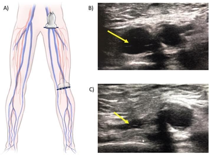 This composite educational graphic illustrates the two-point compression technique for point-of-care ultrasound (POCUS) assessment of deep vein thrombosis (DVT). Panel A is an anatomical diagram of the lower extremities showing the placement of the ultrasound transducer at the common femoral vein (groin level) and the popliteal vein (popliteal fossa). Panels B and C are transverse grayscale B-mode ultrasound images of a vein (marked by yellow arrows) adjacent to an artery. Image B displays the vein in its resting state, appearing as a rounded, anechoic lumen. Image C demonstrates the same vein under external transducer compression; the vessel walls are fully apposed, resulting in complete collapse of the lumen. This visual finding—total venous compressibility—is the primary diagnostic indicator for the absence of intraluminal thrombus. The content is designed for medical professionals and students learning bedside ultrasound protocols for vascular assessment.
