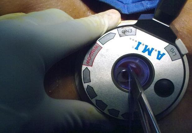 This intraoperative clinical photograph captures a Doppler-guided hemorrhoidal artery ligation (DGHAL) procedure. The primary focus is a specialized circular, silver-colored anoscope head held by a gloved hand. The device is labeled with 'A.M.I.' in blue, alongside functional markings such as 'WINDOW' in red, 'END', and 'LIG'. These indicators assist the surgeon in orienting the side window for precise arterial targeting. Through the central aperture, surgical forceps are visible manipulating a blue absorbable suture needle into the rectal mucosa. This illustrates the ligation phase of treating symptomatic hemorrhoids, where Doppler ultrasound transducers within the anoscope wall first identify arterial signals, allowing for targeted devascularization and mucopexy. The image serves as a high-fidelity educational tool for colorectal surgeons and residents, demonstrating the use of specialized proctological equipment in minimally invasive surgical interventions.