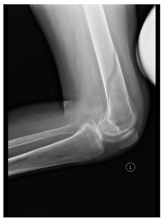 This lateral-view X-ray (radiograph) of the left lower limb demonstrates the distal femur, knee joint, and proximal tibia and fibula. The primary diagnostic finding is a spiral fracture located in the mid-to-distal shaft of the femur. The fracture is characterized by a radiolucent, oblique line that curves around the diaphysis, indicating torsional stress as the mechanism of injury. There is minimal displacement of the femoral fragments, and the cortical alignment is relatively well-preserved despite the discontinuity. The knee joint space appears intact, and the patella is visualized in its expected anterior position. The proximal tibia and fibula show normal bone density and morphology without evidence of additional fractures. This image illustrates a common complication of low-energy trauma in patients with reduced bone mineral density, such as those with chronic spinal cord injuries, where sensory deficits may mask the initial pain of the fracture.