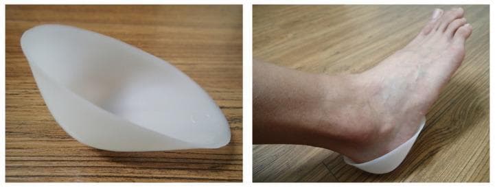 This clinical photograph consists of two panels demonstrating a plastic heel cup, a common orthopedic device used in the management of plantar fasciitis and heel pain. The left panel shows the standalone device: a semi-rigid, translucent white plastic orthotic with a contoured, bowl-like shape designed to anatomically cradle the calcaneal region. The right panel displays the device in situ on a human foot. It illustrates the clinical application where the cup encloses the posterior and plantar aspects of the heel, providing confinement for the soft tissue heel pad. The device is designed to prevent the lateral expansion (collapse) of the heel pad under weight-bearing loads, thereby enhancing shock absorption and reducing plantar pressure. This visual is relevant for orthopedic and podiatric education regarding conservative treatment options for plantar heel pain and mechanical stabilization of the calcaneal fat pad.