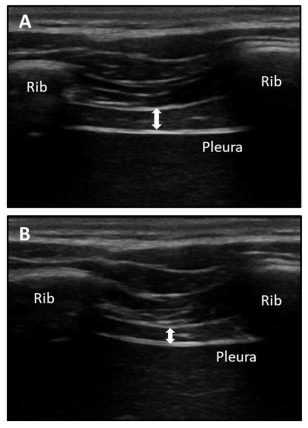 This diagnostic B-mode ultrasound comparison demonstrates the assessment of diaphragm thickness through the last intercostal space (mid-axillary line between the 11th and 12th ribs). Image A displays the diaphragm at maximum inspiration (Tins), while Image B shows it at maximum expiration (Texp). Anatomical landmarks include the hyperechoic ribs on either side of the intercostal window and the bright, hyperechoic linear interface representing the pleura at the deep margin. The diaphragm muscle is visualized between the superficial perimuscular connective tissue and the deep pleura, characterized by mixed echogenicity with hypoechoic muscular tissue and hyperechoic fascial boundaries. White double-headed arrows indicate the specific measurement zone for diaphragm thickness. The comparison illustrates the physiological thickening of the muscle during inspiration (A) compared to its thinner state during expiration (B). This technique is relevant in physical therapy and critical care for evaluating respiratory muscle function and diaphragm atrophy or excursion.