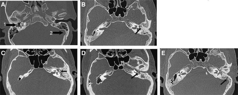 This composite of high-resolution computerized tomography (HRCT) axial scans of the temporal bone demonstrates a progressive classification of middle ear cholesteatoma based on bone destruction. (A) Baseline normal anatomy showing an intact ossicular chain (malleus, incus, and stapes) and a well-defined sigmoid sinus bone plate. (B) Grade (+) showing early soft tissue opacification without definitive ossicular erosion. (C) Grade (++) demonstrating clear destruction of the malleus and/or incus (indicated by arrow). (D) Grade (+++) showing advanced erosion involving the incus and stapes. (E) Grade (++++) exhibiting the most extensive destruction, involving the complete ossicular chain, mastoid tegmen, and/or the sigmoid sinus bone plate (indicated by arrow). Key visual indicators of pathology across the series include increased radiolucency, irregular bone margins, and loss of structural integrity of the auditory ossicles and mastoid air cells. This visual scale serves as a diagnostic tool for assessing the severity of cholesteatoma invasion and its correlation with clinical outcomes such as hearing loss.