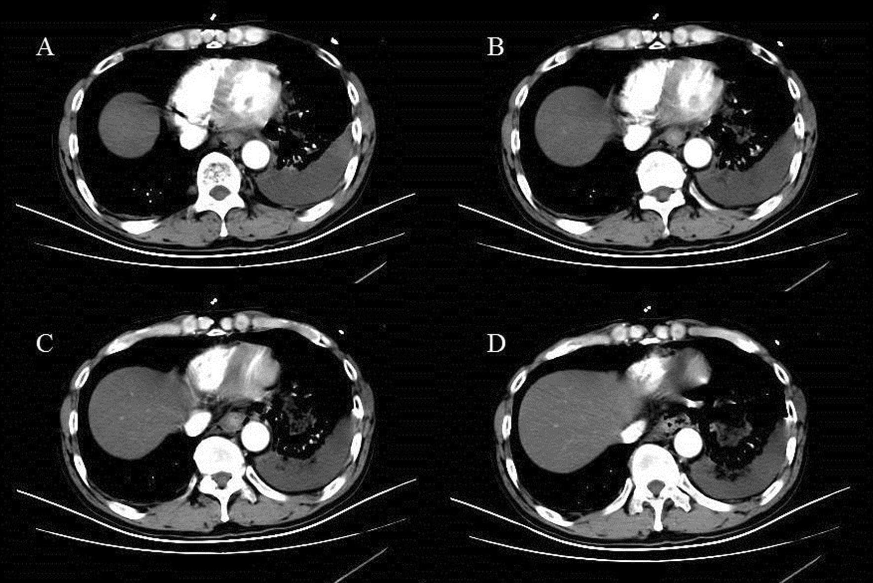 Axial contrast-enhanced CT scans of the chest (labeled A-D) demonstrating hallmark features of Boerhaave’s syndrome (spontaneous esophageal rupture). The images reveal significant pneumomediastinum, characterized by pockets of free extraluminal air tracking around the heart, distal esophagus, and descending aorta. There is clear evidence of air dissecting laterally toward the left pleural space. A large, heterogeneous left-sided pleural effusion is present, causing compressive atelectasis of the adjacent left lower lobe and a mild rightward shift of the mediastinal structures. Small amounts of subcutaneous emphysema are visible in the anterior chest wall. These findings illustrate the typical radiographic progression of esophageal perforation where air and gastrointestinal contents leak into the mediastinum and subsequently into the pleural cavity, leading to hydropneumothorax or complex effusion.