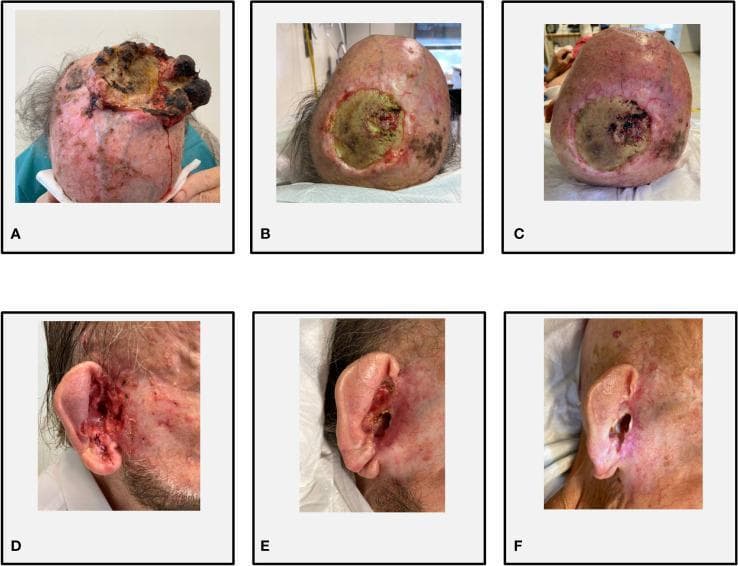 This set of clinical photographs illustrates the therapeutic progression of two distinct types of non-melanoma skin cancer (NMSC) in a single patient. Figures A-C depict a timeline of a bulky, recurrent cutaneous squamous cell carcinoma (cSCC) on the cranial vertex. Image A shows a large, exophytic, and friable mass with significant necrosis and ulceration. Figures B and C demonstrate a partial response and subsequent stable disease under combined cemiplimab and sonidegib therapy, characterized by marked flattening of the lesion, re-epithelialization of the margins, and reduction in hemorrhage. Figures D-F show an infiltrative basal cell carcinoma (BCC) extending into the right external auditory meatus. Image D displays an infiltrative, ulcerated lesion involving the auricular canal. Images E and F show the progression from a partial to a complete response, with Figure F demonstrating total resolution of the tumor and restoration of the normal anatomical contours of the ear canal. The series serves as an educational example of the efficacy of immune checkpoint inhibitors combined with Hedgehog pathway inhibitors in treating synchronous, advanced keratinocyte carcinomas.