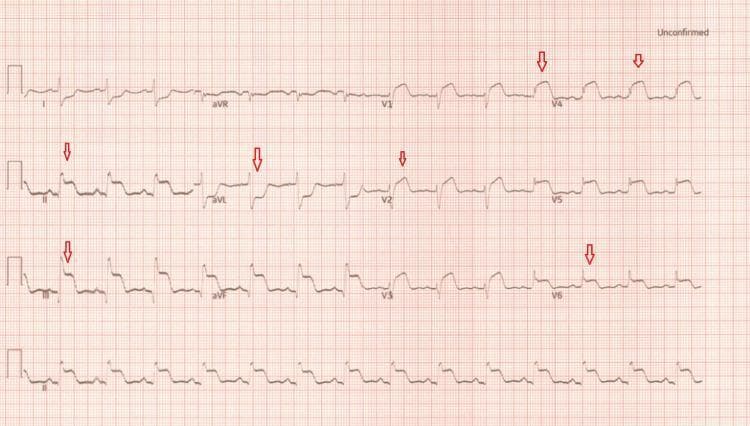 This diagnostic image is a 12-lead electrocardiogram (ECG) demonstrating acute ST-segment elevation myocardial infarction (STEMI). The tracing reveals a sinus rhythm with significant ST-segment elevation in the inferior leads (II, III, and aVF) and the anterior precordial leads (V1 through V4), highlighted by red arrows. Notably, there is reciprocal ST-segment depression in the high lateral leads (I and aVL). The anterolateral leads (V5 and V6) show T-wave inversions. These findings indicate widespread myocardial ischemia or injury involving multiple vascular territories, specifically the inferior and anterior walls. The clinical significance of this ECG suggests acute occlusion of major coronary arteries, such as the right coronary artery (RCA) and left anterior descending (LAD) artery, requiring urgent intervention. This visual is an educational example of multi-territory STEMI and the identification of reciprocal changes in a clinical cardiology context.