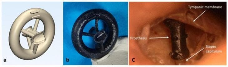 This composite figure illustrates the design and clinical application of a patient-specific 3D-printed middle ear prosthesis. (a) A digital Standard Tessellation Language (STL) model showcasing a circular support ring connected via three spokes to a central component, designed to replicate the function of a human incus. (b) A physical 3D-printed model of the prosthesis fabricated using vat photopolymerization (VP) technology, displaying the textured surface typical of high-resolution resin printing. (c) An intraoperative clinical photograph demonstrating the prosthesis in situ within a left middle ear. The image highlights the mechanical coupling between the manubrium of the malleus and the stapes capitulum, bridging the ossicular chain gap to facilitate sound transmission. Labeled anatomical landmarks include the tympanic membrane and the stapes capitulum. This demonstrates the use of computer-aided design (CAD) and medical 3D printing for otologic reconstruction and patient-specific surgical planning in the treatment of conductive hearing loss.