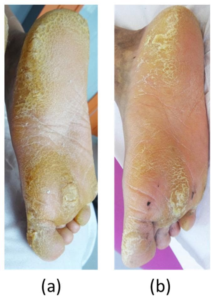 This clinical photograph exhibits a comparison of the plantar surface of the foot in a patient with pachyonychia congenita (specifically KRT6A-associated palmoplantar keratoderma), showing treatment progression over 11 months. Panel (a) illustrates the baseline condition characterized by severe, focal hyperkeratosis with thick, yellowish, and fissured plaques on the heel, lateral border, and metatarsal heads. The skin texture is markedly rough, and deep cracks are visible in weight-bearing areas. Panel (b) shows the result after 11 months of oral erlotinib therapy, demonstrating a significant reduction in the thickness and extent of the keratoderma. The yellowish hyperkeratotic plaques have noticeably thinned, the surface appears smoother, and the deep fissures are largely resolved. The skin tone is more uniform, and the inflammatory borders are less prominent. This comparison serves as a clinical demonstration of the efficacy of EGFR inhibitors in managing the hyperkeratotic symptoms of keratin-related disorders.