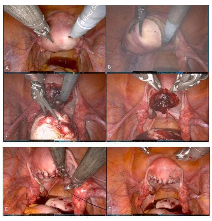 A series of six intraoperative endoscopic photographs (A-F) documenting a coaxial-robotic single-site myomectomy (C-RSSM). Panel (A) shows the initial robotic camera view of the uterus with surgical instruments positioned at the pelvic cavity. Panel (B) depicts the uterine serosal incision and the application of traction and countertraction to the intramural myoma. Panel (C) demonstrates the use of a robotic tenaculum grasper for powerful traction during the enucleation process. Panel (D) reveals the resulting uterine defect (cavity) after the myoma has been fully enucleated, showing visible hemorrhagic tissue within the bed. Panel (E) illustrates the reconstructive phase, where a mega-needle driver is used to perform layer-to-layer suturing of the uterine wall with barbed sutures. Panel (F) displays the final post-procedural state with the uterine defect successfully closed and anatomical integrity restored. The images highlight the limited range of motion and instrument positioning characteristic of single-site robotic gynecological surgery.