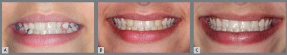 This Comparison Chart consists of three intraoral clinical photographs (A, B, C) demonstrating the sequential progression of an orthodontic and esthetic restorative treatment for a patient with maxillary lateral incisor agenesis.