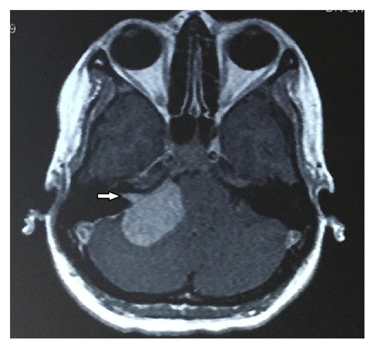 This axial magnetic resonance image (MRI) of the head shows a large, well-defined, ovoid extra-axial mass within the right cerebellopontine angle (CPA) cistern. The lesion demonstrates relatively homogeneous signal intensity and exerts a mild mass effect on the adjacent brainstem and cerebellum. A characteristic visual feature is the extension of the tumor into the right internal auditory canal (IAC), creating a triangular or 'shark fin' appearance (indicated by a white arrow). This morphology and location are classic diagnostic markers for a vestibular schwannoma (acoustic neuroma). The image illustrates the common radiological finding of subtle widening of the internal auditory canal caused by tumor progression. This material is suitable for medical education in neuroradiology, neurosurgery, and otolaryngology to identify CPA lesions and their involvement with cranial nerve pathways.
