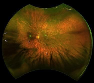 This Scanning Laser Ophthalmoscopy (SLO) image depicts the left eye fundus of a patient following Spontaneous Regression of Rhegmatogenous Retinal Detachment (SRRRD). The wide-field imaging modality shows several key pathological findings. A black arrowhead identifies a focal patch of green-tinged glial tissue located nasal (to the left) of the optic disc. Retinal tears (RT) are visible at approximately the 6:00 and 9:00 o'clock peripheral positions, marked by white arrowheads. The retinal surface exhibits widespread structural changes, including altered texture and corrugated folds, particularly in the inferior and nasal quadrants, which are indicative of chronic retinal detachment and subretinal fluid absorption. Vascular irregularities and pigmentary changes suggest previous retinal pigment epithelium (RPE) stress. This clinical photograph serves as an educational example of the retinal architecture's appearance during spontaneous reattachment and the resulting fibrotic complications such as epiretinal membrane or glial proliferation.