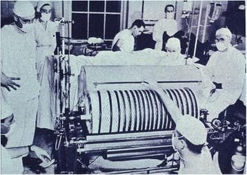 This historical clinical photograph depicts an early iteration of a medical dialyzer, specifically the Kolff-Alwall rotating drum kidney, used for hemodialysis. The device features a large, horizontally oriented cylindrical drum constructed with longitudinal ridges. Wrapped around this drum are numerous parallel windings of semi-transparent cellophane tubing, which served as the semi-permeable membrane for blood filtration. The tubing is visible as dark bands against the lighter drum surface, representing the path where blood would flow to facilitate solute exchange via osmosis and diffusion when submerged in a dialysate bath. The apparatus is surrounded by medical staff in surgical attire, including masks and caps, highlighting the clinical setting of early renal replacement therapy. Supporting infrastructure including intake/output pipes and a metal frame for drum rotation are visible, illustrating the mechanical complexity required to treat acute renal failure before the miniaturization of modern hollow-fiber dialyzers.