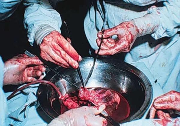 This historical clinical photograph illustrates a key stage in the first Brazilian heart transplant procedure, specifically the preparation of the donor heart. The image shows a donor heart placed within a stainless steel surgical basin, partially submerged in a blood-filled solution. Multiple surgical hands are visible, some gloved and others appearing bare and heavily stained with blood, reflecting historical surgical practices. The surgeons are utilizing instruments, including forceps and a cannula inserted into the vascular structures of the heart, to facilitate continuous normothermic blood perfusion of the organ prior to transplantation. The heart tissue appears intact with visible anatomical structures, including major vessels and atrial/ventricular walls. This visual documents the early technical challenges and methodologies of cardiac transplantation, specifically the preservation and preparation of the graft using warm blood perfusion techniques rather than modern cold storage methods.