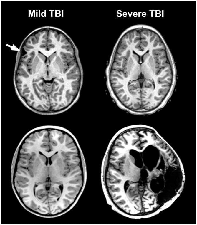 This comparison chart displays four axial T1-weighted magnetic resonance imaging (MRI) slices of the brain, categorized by Traumatic Brain Injury (TBI) severity to illustrate the disparity between clinical Glasgow Coma Scale (GCS) scores and structural pathology. The left column shows two cases classified as 'Mild TBI'. The top left slice exhibits focal encephalomalacia in the frontal lobe (indicated by a white arrow) and subtle asymmetry of the anterior horn of the lateral ventricle, suggesting regional parenchymal volume loss. The bottom left slice shows no visible gross abnormalities. The right column displays 'Severe TBI' cases. The top right slice appears structurally normal despite a low GCS score, while the bottom right slice demonstrates massive structural damage, including profound parenchymal loss, severe brain distortion, and large fluid-filled cystic cavities or significantly enlarged ventricles. This visual comparison highlights the heterogeneity of neuropathological outcomes in TBI, emphasizing that clinical severity indices may not fully reflect underlying structural integrity or long-term neuroanatomical changes.