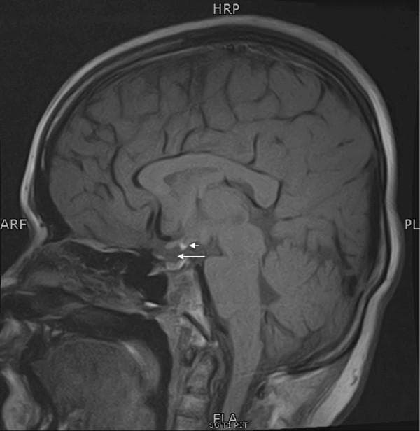 This diagnostic image is a midline sagittal T1-weighted MRI scan of the brain, specifically focusing on the sellar and suprasellar regions. It demonstrates Pituitary Stalk Interruption Syndrome (PSIS). The anterior pituitary gland is visible within the sella turcica, exhibiting normal signal intensity but appearring somewhat small (hypoplastic). A long white arrow indicates the expected location of the pituitary stalk (infundibulum), which is notably absent or non-visualized. A short white arrow identifies an ectopic posterior pituitary, seen as a characteristic T1-hyperintense focus (bright spot) located at the median eminence of the hypothalamus rather than its normal posterior position in the sella. This triad of findingsโectopic posterior pituitary bright spot, absent or attenuated pituitary stalk, and anterior pituitary hypoplasiaโis a classic radiological presentation of congenital hypopituitarism. The surrounding neuroanatomical structures, including the corpus callosum, pons, and cerebellum, appear within normal limits.