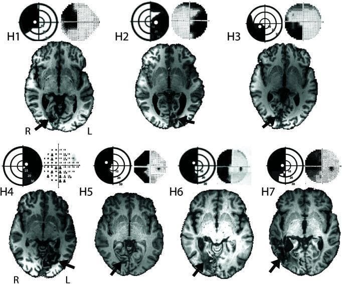A comparison panel of diagnostic images and visual field plots for seven clinical participants (H1-H7). Each entry consists of an axial T1-weighted structural MRI scan and a corresponding automated perimetry report (adapted from Humphrey 30:2 threshold tests). In the MRI scans, black arrows indicate varying degrees of structural damage within the occipital lobe, specifically targeting the region around the calcarine sulcus. The lesions demonstrate heterogeneity in morphology and volume. The accompanying perimetry plots represent visual field deficits: solid black areas indicate dense scotomas (sensitivity <0.5%), while gray areas indicate partial loss (sensitivity <2%). Concentric rings on these circular plots mark 10-degree increments from the fixation point, covering the central 30 degrees of the visual field. A superimposed white circle in each plot identifies the specific location within the dense scotoma used for rehabilitation training. This visual summary illustrates the clinical correlation between posterior brain lesions and complex hemianopic or quadrantanopic visual field deficits in patients undergoing neuro-rehabilitation.