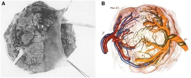 This figure presents the vascular anatomy of a monochorionic twin placenta through a clinical photograph (A) and a detailed anatomical diagram (B). Panel A shows the gross morphology of a single placental disc featuring a dividing amnion tissue membrane and the insertion of two distinct umbilical cords. The chorionic plate surface exhibits a complex network of superficial fetal vessels. Panel B provides a diagrammatic representation of the shared placental circulation, illustrating vascular anastomoses between the two fetal systems. The diagram labels umbilical cords as 'F' and 'F1', representing each twin, and highlights five numbered sites (1-5) of vascular interconnection. Arterial and venous vessels are color-coded (red, blue, and orange) to demonstrate the branching patterns and anastomotic pathways. This educational visual explains the anatomical basis for shared circulation in monozygotic twins, which is clinically significant for understanding conditions such as twin-twin transfusion syndrome (TTTS) and in utero cellular chimerism.