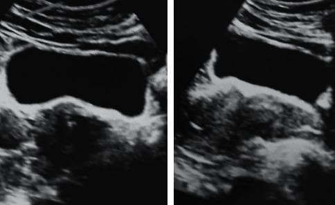 Two diagnostic ultrasound images of the pelvic region demonstrate the classical sonographic findings of Polycystic Ovary Syndrome (PCOS). The images show bilateral ovarian enlargement, with the right ovary measuring 14 ml and the left ovary measuring 17 ml. Both ovaries exhibit a characteristic distribution of multiple small, subcentimeter, hypoechoic follicles located at the periphery, creating a 'string of pearls' appearance. There is a notable increase in the central echogenicity and volume of the ovarian stroma, termed stromal hyperplasia or prominent stroma. These visual features are consistent with the Rotterdam criteria for polycystic ovary morphology in a clinical context of hyperandrogenism. This image serves as an educational reference for identifying gynecological pathology through ultrasonography, specifically highlighting morphological changes in the adnexa associated with endocrine disorders like PCOS and ovarian hyperthecosis.