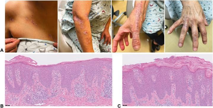 This composite educational image illustrates the clinical and histopathological features of Inflammatory Linear Verrucous Epidermal Nevus (ILVEN). Panel A presents clinical photographs showing erythematous to violaceous, scaly papules and plaques. These lesions exhibit a distinct linear arrangement following the Lines of Blaschko, extending from the right pectoral region down the upper extremity to the dorsal aspect of the fingers. Panels B and C are high-power photomicrographs (H&E stain) of skin biopsies from the chest and wrist. Pathological findings include marked epidermal acanthosis and spongiosis. A key diagnostic feature shown is the characteristic horizontally alternating pattern of orthokeratosis and parakeratosis within the stratum corneum. The underlying papillary dermis reveals a superficial perivascular lymphocytic infiltrate. This presentation is a classic example used in dermatology to differentiate ILVEN from other Blaschkoid dermatoses such as linear psoriasis or lichen striatus based on chronicity and specific histomorphological patterns.