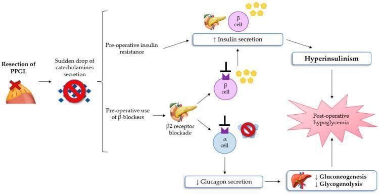This pathophysiology diagram illustrates the mechanisms leading to post-operative hypoglycemia following the resection of pheochromocytoma and paraganglioma (PPGL). The algorithm starts with the surgical removal of the PPGL tumor, resulting in a sudden drop in catecholamine secretion. This drop triggers two main pathways. First, pre-operative insulin resistance combined with the removal of catecholamine-induced inhibition leads to increased insulin secretion from pancreatic beta cells, causing hyperinsulinism. Second, pre-operative use of beta-blockers results in beta-2 receptor blockade. This blockade inhibits both beta cells and alpha cells; specifically, it decreases glucagon secretion from alpha cells. The reduction in glucagon leads to diminished hepatic gluconeogenesis and glycogenolysis. The convergence of hyperinsulinism and decreased glucose production by the liver results in the clinical outcome of post-operative hypoglycemia. The diagram utilizes icons for the adrenal gland, pancreas, and liver to represent the multi-organ involvement in glucose homeostasis alterations post-PPGL resection.