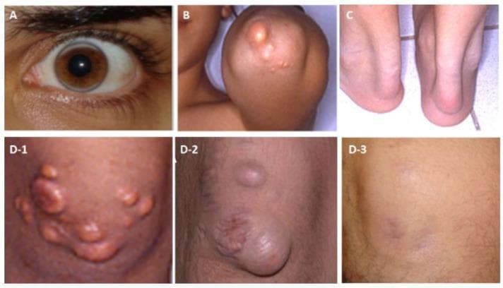 A multi-panel clinical photograph collection documenting physical manifestations of homozygous familial hypercholesterolemia (HoFH) and the effects of lipoprotein apheresis. Image A shows arcus lipoides (corneal arcus), characterized by a hazy, whitish-gray lipid ring at the corneal periphery. Image B demonstrates tuberous xanthomas on the extensor surface of the elbow, appearing as firm, yellowish-orange nodules. Image C illustrates tendon xanthomas, specifically bilateral thickening and prominence of the Achilles tendons. Panels D-1 through D-3 provide a longitudinal view of cutaneous xanthomas on the extensor surface of the knee. D-1 shows multiple eruptive and tuberous xanthomas before starting apheresis. D-2 shows the progression after a three-year discontinuation of apheresis, with significant enlargement and confluence of the nodules. D-3 demonstrates near-complete resolution of the xanthomas following three years of regular apheresis, with only residual skin hyperpigmentation. These images collectively serve as educational material for the dermatological and ophthalmological signs of severe hyperlipidemia and the visible efficacy of lipid-lowering interventions.
