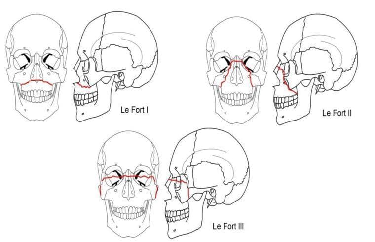 Anatomical diagram illustrating the Le Fort classification system for midface fractures, presented through frontal (anterior) and lateral (profile) line drawings of a human skull. Three distinct fracture patterns are highlighted with red lines. Le Fort I (horizontal) depicts a fracture line passing through the lower maxilla and nasal septum, effectively separating the alveolar process and palate from the rest of the facial skeleton. Le Fort II (pyramidal) shows a fracture line originating at the nasal bridge, extending through the lacrimal bones, infraorbital rim, and downward through the maxillary sinuses. Le Fort III (craniofacial dysjunction) illustrates a complete separation of the facial bones from the cranial base, with fracture lines traversing the frontonasal suture, orbits, and zygomatic arches. This diagram serves as a primary educational resource for maxillofacial surgery and emergency medicine, demonstrating the complex planes of facial trauma and the anatomical relationship between the maxilla, orbits, and zygoma.